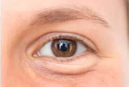eyelid-Before