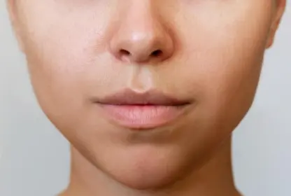 facelift-After