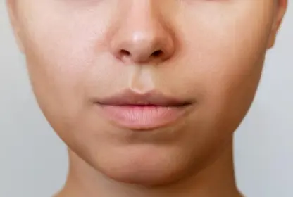 facelift-Before